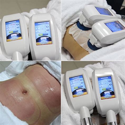 Cryolipolysis crows nest  Read on to learn more about Cryolipolysis